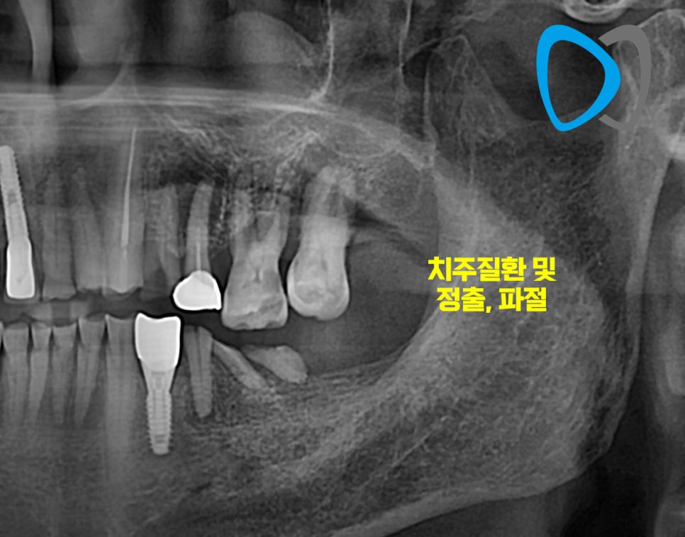 치료 전