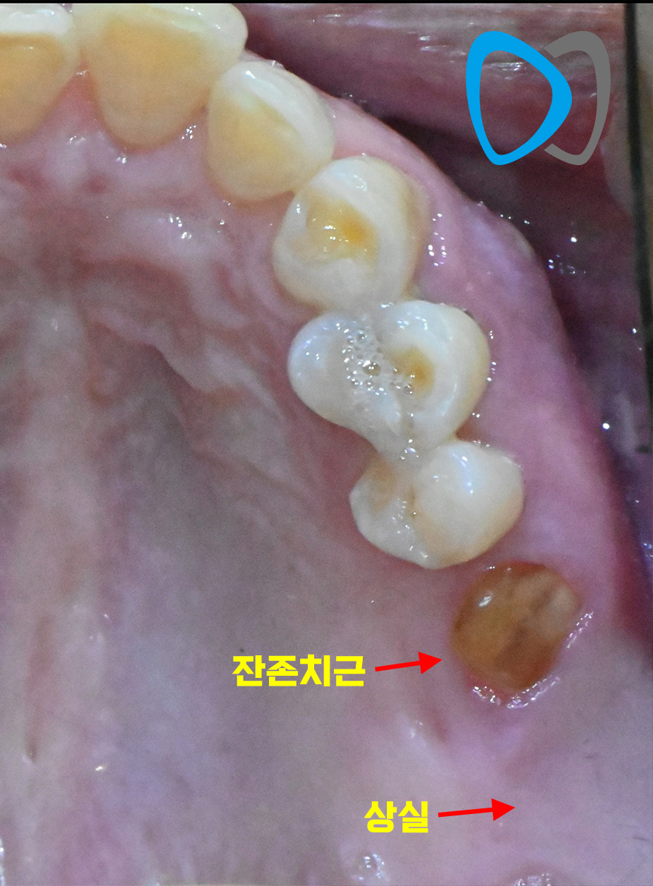치료 전